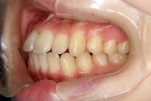 子供の矯正歯科治療。円山さくらび矯正歯科。